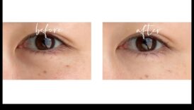 אליקסירים מתחת לעיניים: הרחקת עיגולים כהים עם הקונסילר המושלם